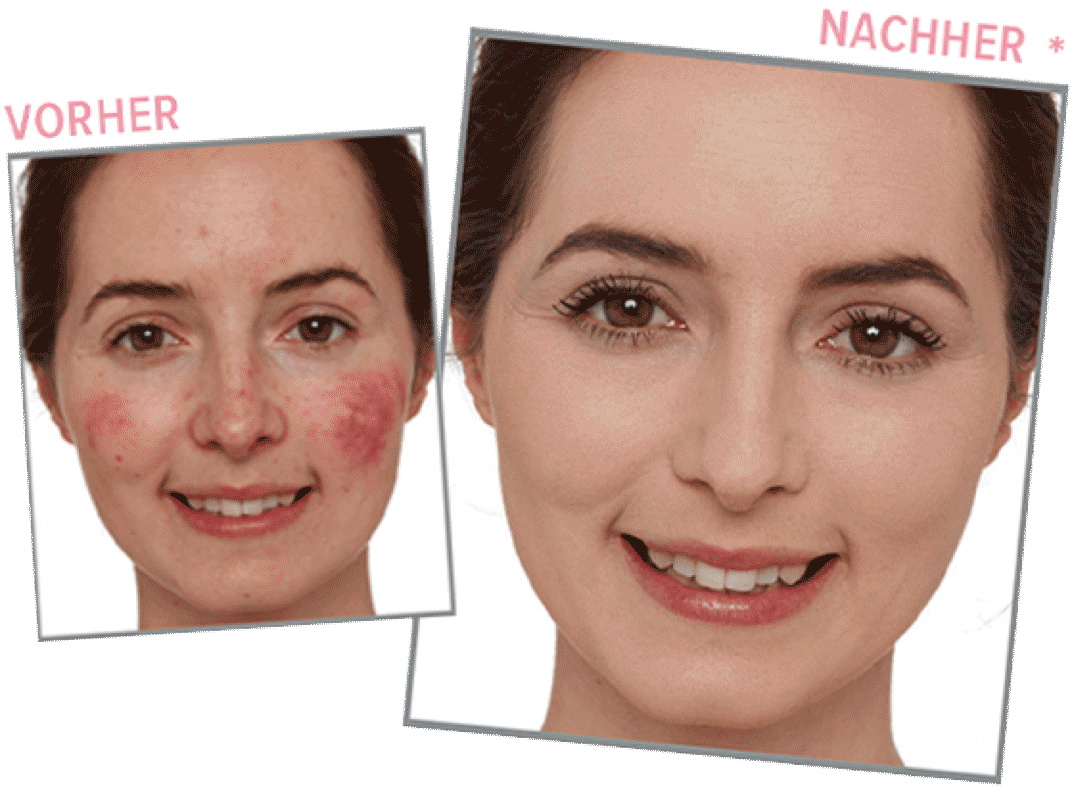 Make Up Bei Rosacea It Cosmetics