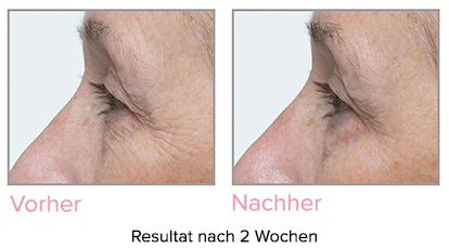 Vorher & nachher