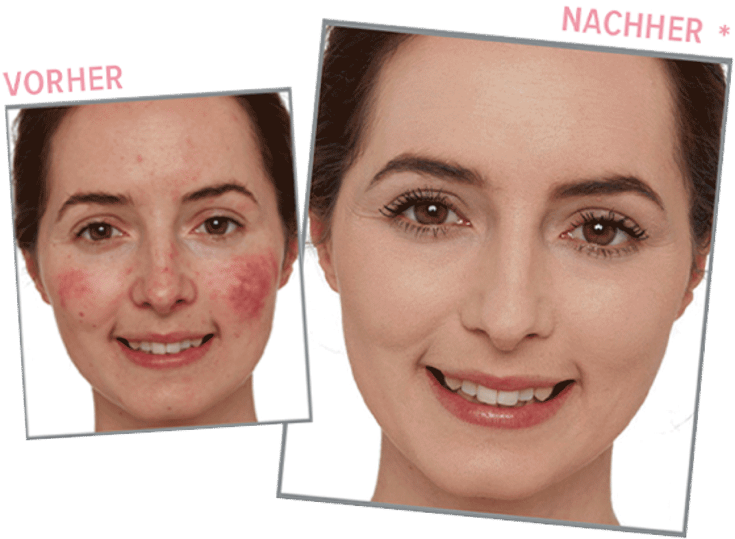 Rosacea