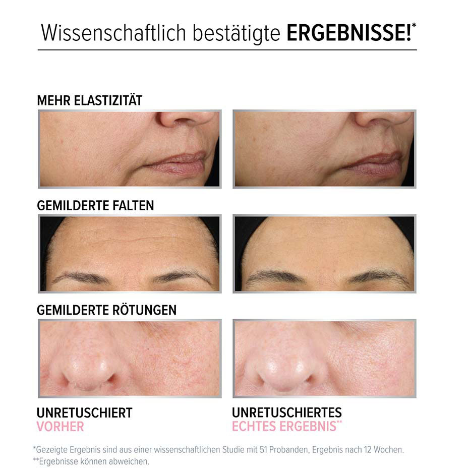 Hello Results Serum-In-Creme mit Retinol: Vorher-Nachher-Ergebnis nach 12 Wochen Anwendung